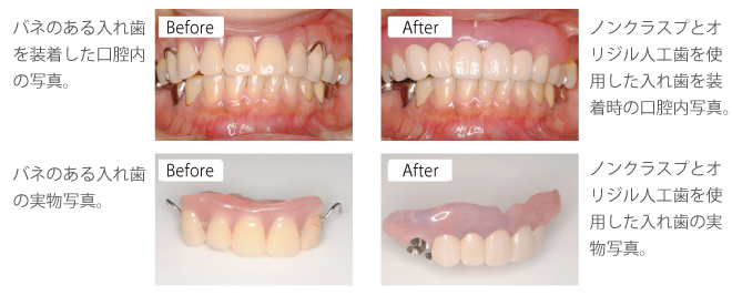 non_clasp_prosthetic tooth1 オリジナル人工歯症例 non_clasp_prosthetic tooth1 オリジナル人工歯症例