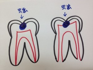 歯医者さん事典vol 43 生えたばかりの永久歯は虫歯になりやすい 札幌マタニティー歯科 札幌で女性のための歯医者