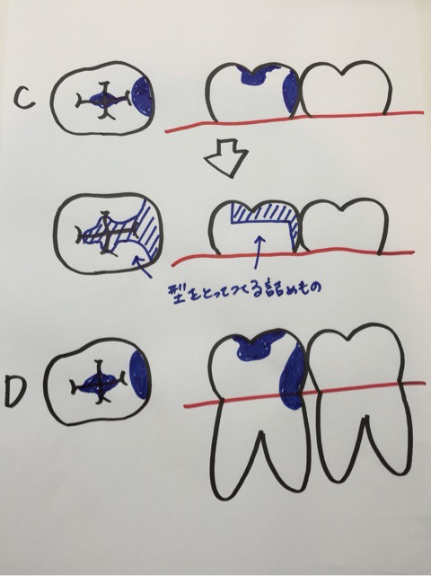 歯医者さん事典vol 114 歯に直接白い詰め物が出来る虫歯と出来ない虫歯の違いって 札幌マタニティー歯科 札幌で女性のための歯医者
